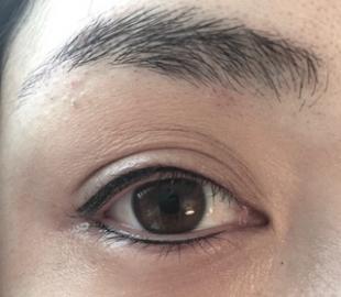 Direkt nach der Behandlung